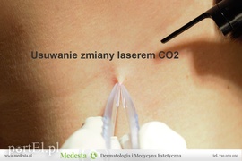 Laserowe usuwanie zmian okolic intymnych (brodawki, polipy, kłykciny)